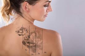 Tattoo laseren, tattoo cover up